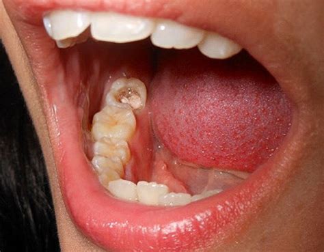 infeksi gigi